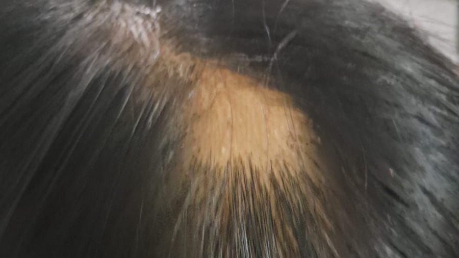 Alopecia Areata